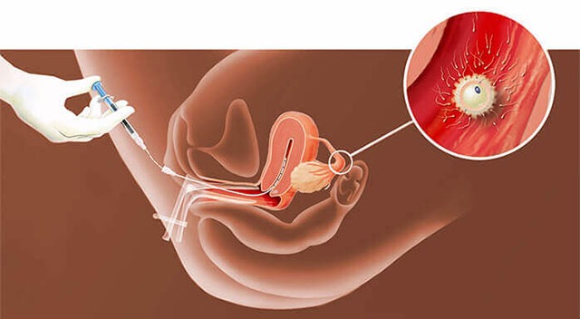 Iui treatment in ahmedabad – ayuh fertility center 1 Close-up of iui treatment injection being administered at ayuh fertility centre.