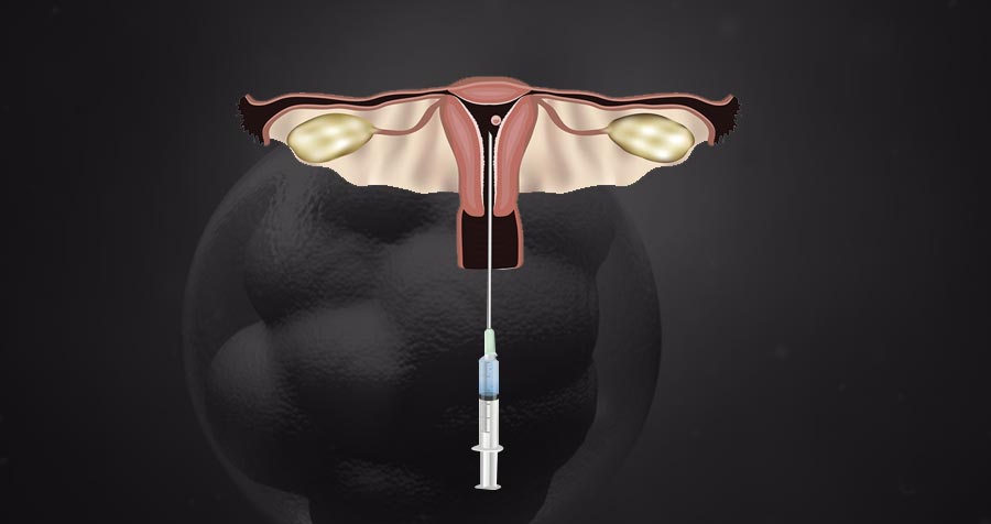Embryo transfer | the final step towards parenthood 1 Medical illustration showing single embryo transfer procedure for ivf at ayuh fertility centre.