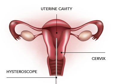 Diagram showing the uterus and uterine cavity during hysteroscopy treatment procedure.