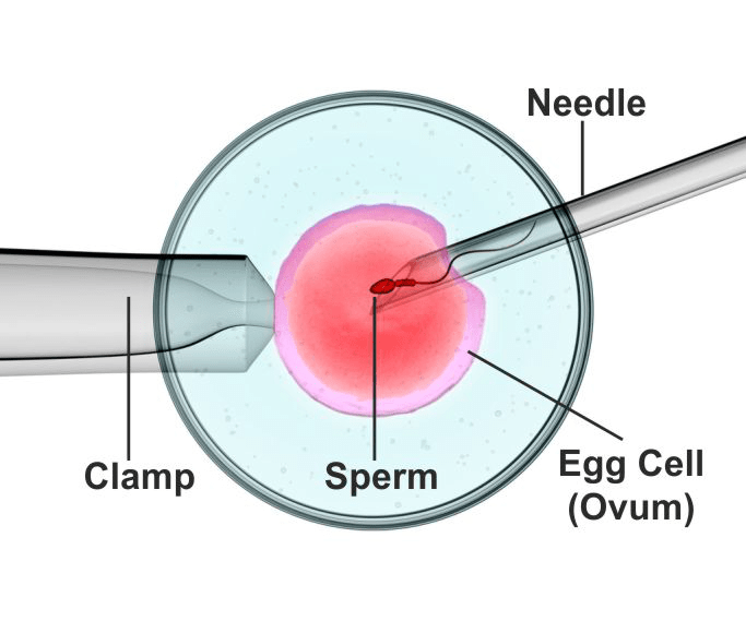 🤰 intracytoplasmic sperm injection (icsi) | fertility treatment in ahmedabad 1 Icsi treatment – injecting sperm directly into an egg under microscope at ayuh fertility centre.