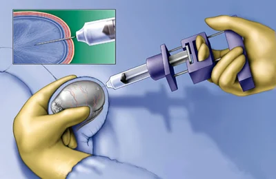 Testicular sperm retrieval procedure for fertility treatment